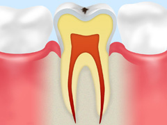 C0　ごく初期のむし歯
