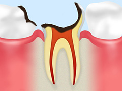 C4　歯の根のむし歯