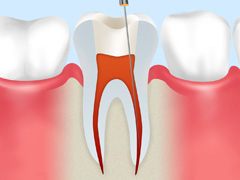 歯の根の治療