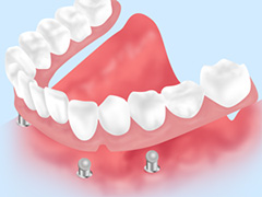 インプラントオーバーデンチャー/ロケーター義歯