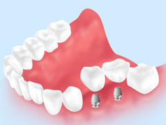 インプラント治療